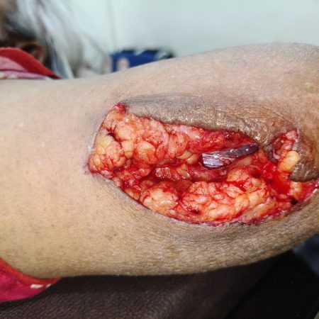 Lacerated wound 1