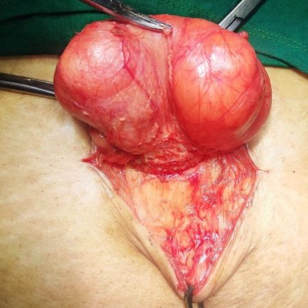umbelical hernia 1